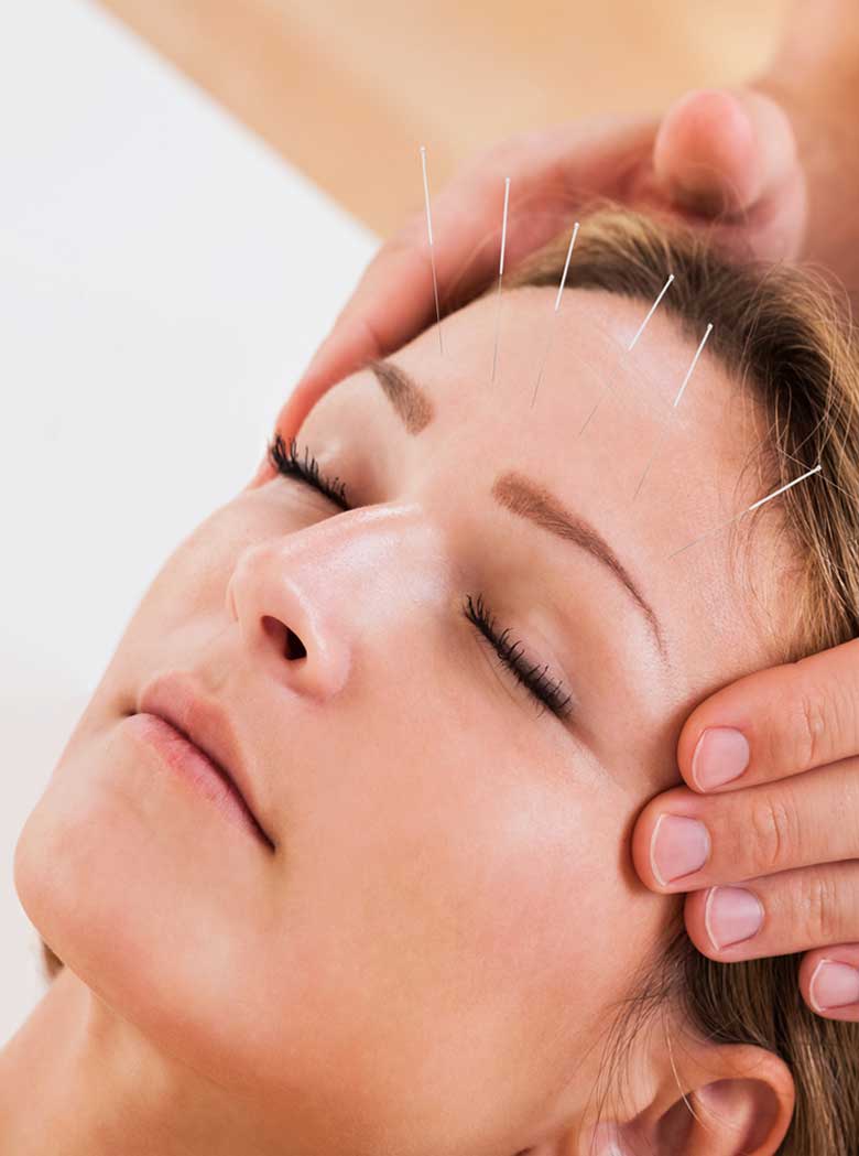 acupuncture